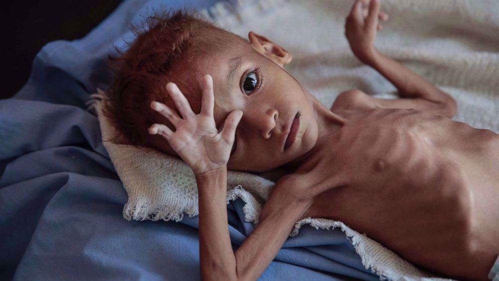 UNICEF says war in Yemen has killed or maimed 10,000 children