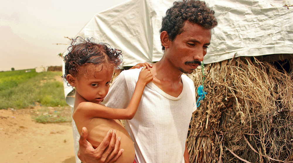 Child malnutrition hits highest levels in Yemen amid COVID-19: UN