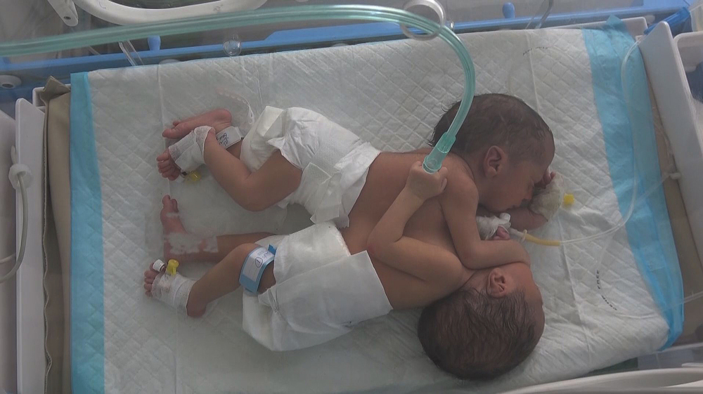 Siamese twins at risk of death due to continuing siege
