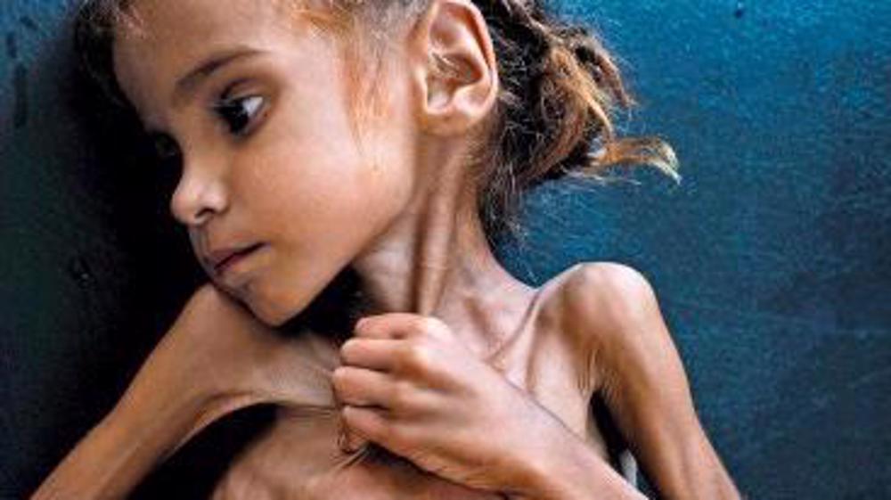 Amal: striking symbol of Yemen's humanitarian crisis