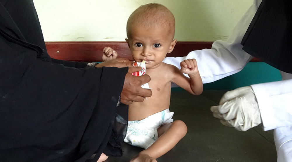 75% of Yemeni children suffer from acute malnutrition amid Saudi war: WHO