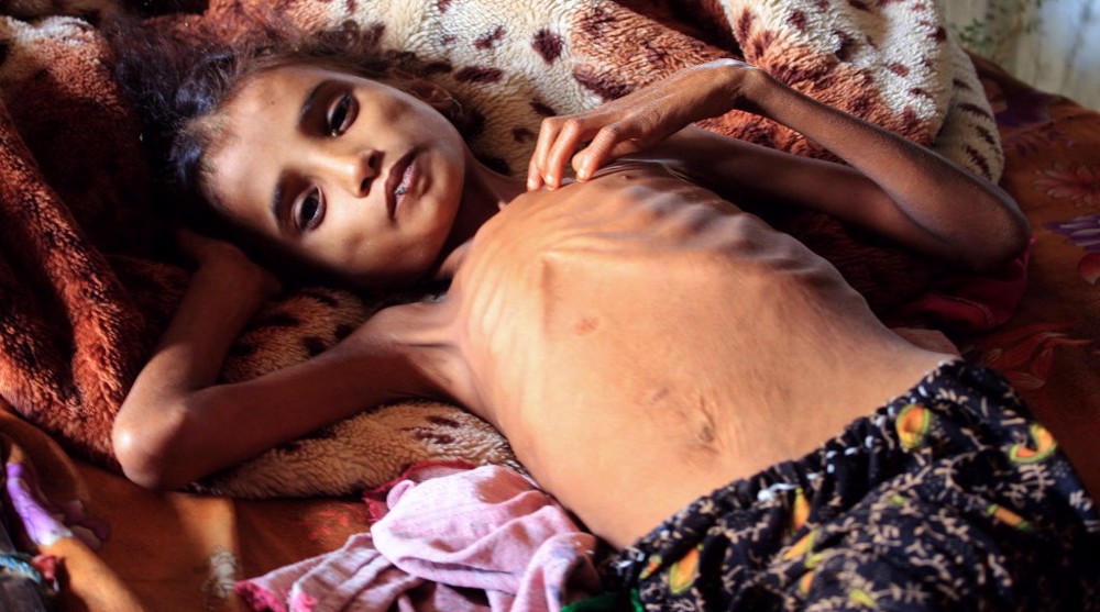 Nearly 400K Yemeni children under five could starve to death in 2021: UN agencies