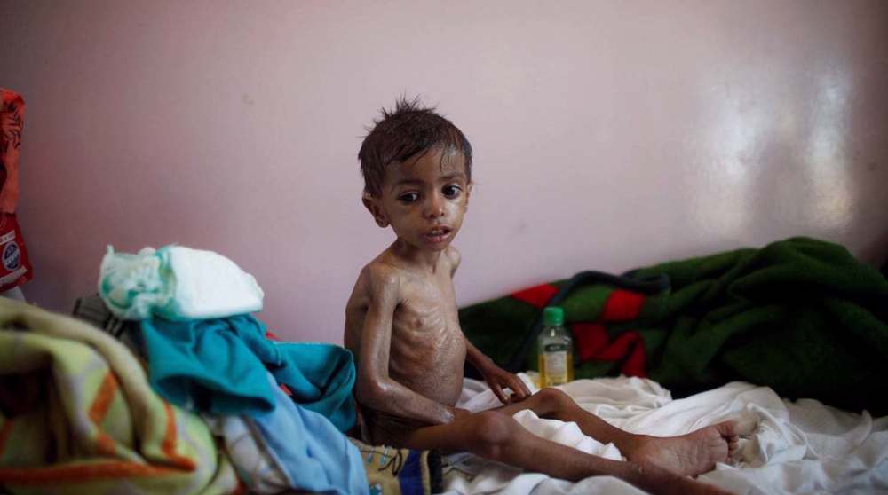 One child in Yemen dies every five minutes as half of medical facilities are out of service: Health Ministry