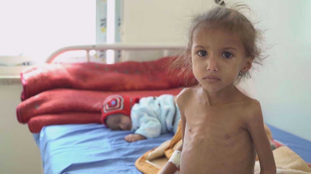Health officials report 4 million cases of malnutrition in Yemen