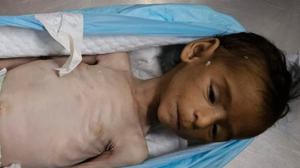 Third Palestinian child succumbs to Israeli-enforced starvation in Gaza in a single day