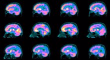 Iran’s nuclear scientists develop radio drug that detects Alzheimer’s decades early 