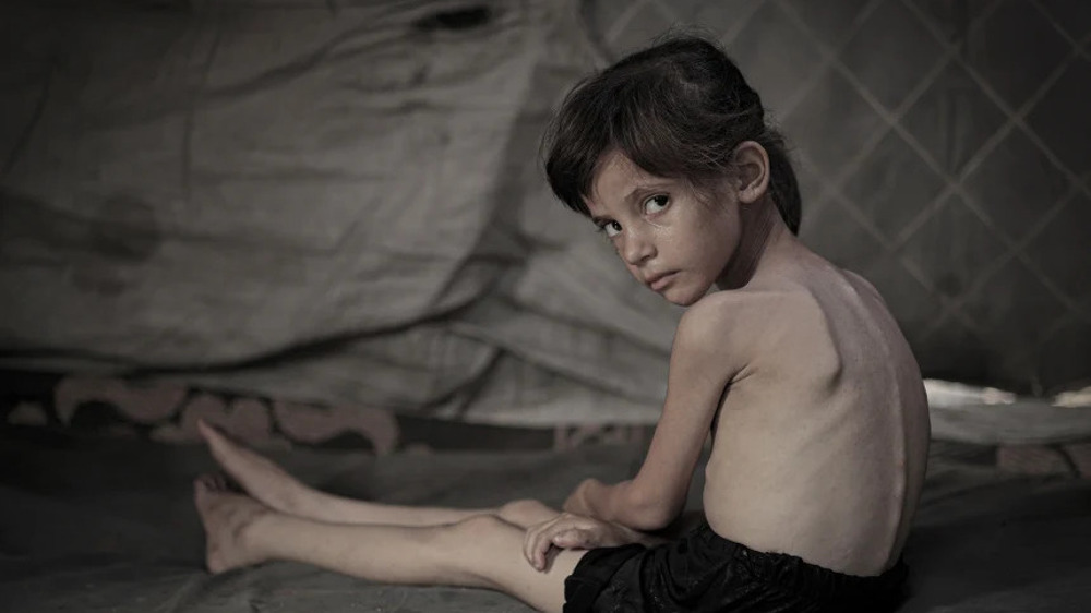 Gaza: tous les enfants de moins de cinq ans menacés de malnutrition aiguë 