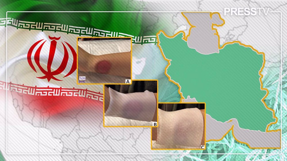 Iran pioneers future of wound care with West Asia’s first smart nanocellulose dressing