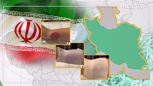 Iran pioneers future of wound care with West Asia’s first smart nanocellulose dressing