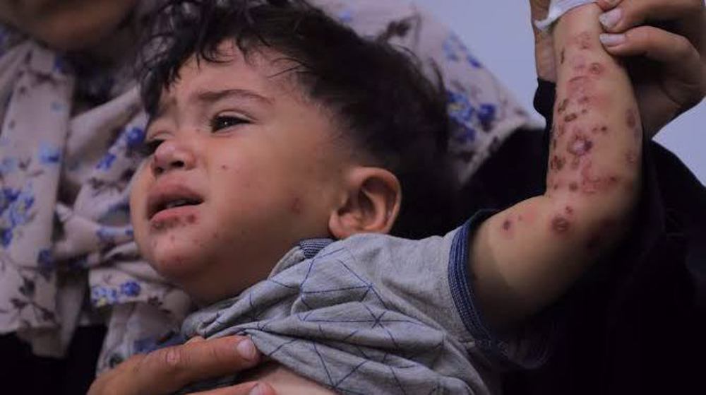 Gaza reports over 125,000 cases of rat- and parasite-linked infections: UNRWA