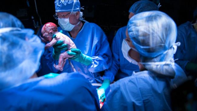First baby born from transplanted uterus ‘healthy’