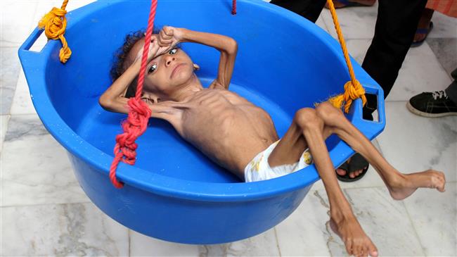 'Yemen alarmingly facing growing cases of malnutrition'