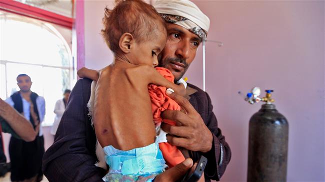 1 in 3 Yemeni kids suffer from severe malnutrition 