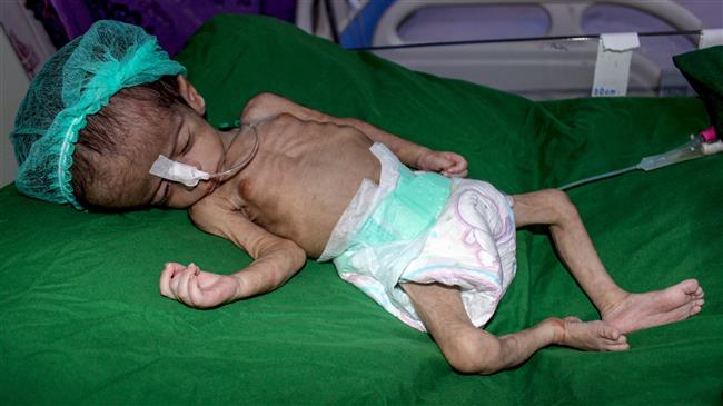Saudi war killed 3,600 Yemeni children, paralyzed 800